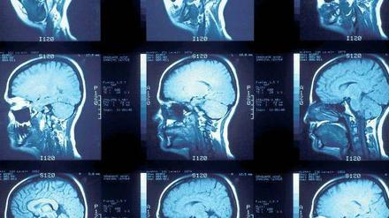 Die Computertomographie hilft, Hirnschäden zu entdecken.