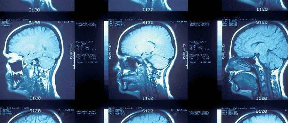 Die Computertomographie hilft, Hirnschäden zu entdecken.