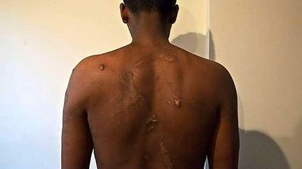Spuren der Gewalt: Auf dem Sinai werden entführte Afrikaner auch gefoltert. 