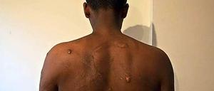Spuren der Gewalt: Auf dem Sinai werden entführte Afrikaner auch gefoltert. 