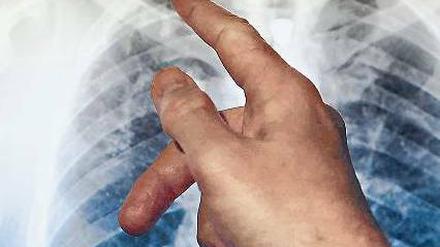 Röntgenbild eines Tuberkulosekranken.
