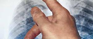 Röntgenbild eines Tuberkulosekranken.