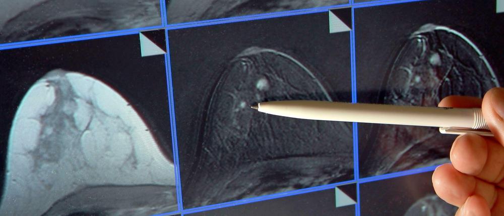 Darstellung einer Magnetresonanz-Mammografie mit sichtbarer Tumorbildung.