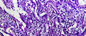 Eingefärbte Magenkrebszellen unter dem Mikroskop.