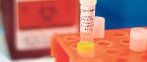 Blutproben erkrankter Ebola-Patienten.