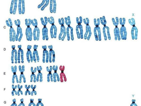 Gewissheit. Schon im Ultraschall können Ärzte einige Fehlbildungen des Fötus erkennen. Gewissheit bringt ein Karyogramm, eine bildliche Darstellung des Chromosomensatzes.