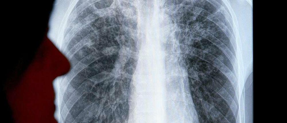 Die Leiterin des Berliner Tuberkulose-Zentrums, Gisela Glaser-Paschke, wertet in dem Zentrum in der Bundeshaupstadt die Röntgenaufnahme eines Patienten aus.
