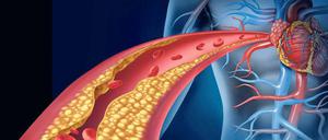 Normalerweise entfernt HDL Cholesterin-Ablagerungen von den Wänden der Schlagadern und weitet die Gefäße.