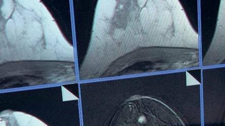 Gefährlich? Die Mammografie kann unnötig Angst machen – oder Leben retten.