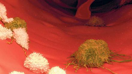 Dem Immunsystem helfen. T-Zellen haben eingebaute molekulare Bremsen. Sie schwächen ihre Angriffskraft. Werden die Bremsen entfernt, können T-Zellen Tumoren besser attackieren. Im Bild greifen T-Zellen (weiß) Krebszellen (gelb) an.