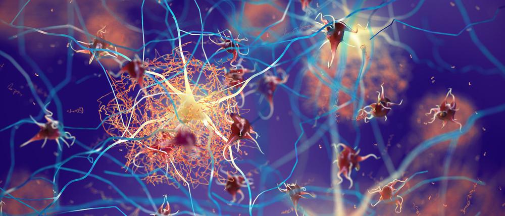 Amyloid plaques in Alzheimer s disease, illustration Amyloid plaques in a brain with Alzheimer s disease, illustration. *** Amyloid plaques in Alzheimer s disease, illustration Amyloid plaques in a brain with Alzheimer s disease, illustration PUBLICATIONxINxGERxSUIxHUNxONLY NOBEASTSOFIERCE/SCIENCExPHOTOxLIBRARY F031/0860 