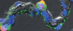 Mit Mers infizierte Lungenbläschen.