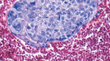 Entdeckt. Brustkrebsabsiedlung (purpur) in einem Lymphknoten.