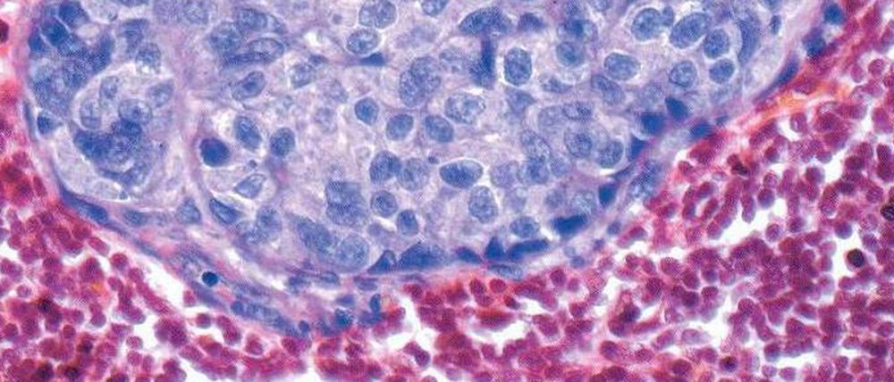 Entdeckt. Brustkrebsabsiedlung (purpur) in einem Lymphknoten.