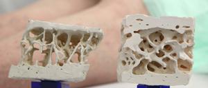 Wenn die knochenbildenden Zellen nicht mehr genug Skelettmasse aufbauen, dann verwandelt sich das stabile Gewebe (rechts) kaum merklich über die Jahre zu einem ein porösen, leicht brüchigen Knochenrest (links).