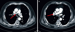 Lungenembolien lassen sich mit Hilfe der Computertomographie erkennen. Dabei werden dem Patienten Kontrastmittel in die Blutbahn gespritzt. Wenn das Kontrastmittel dann im CT-Bild von den Lungenarterien nicht wie erwartet zu erkennen ist, deutet das auf ein verschlossenes Blutgefäß hin - eine Lungenembolie.