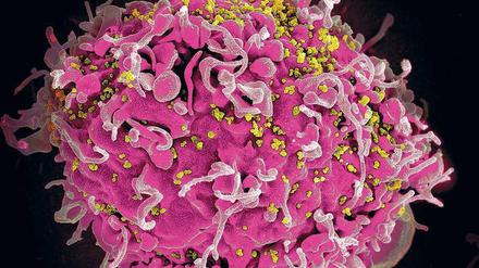 Infiziert. Elektronenmikroskopische Aufnahme von HIV-Viren, die eine menschliche Zelle kapern. 