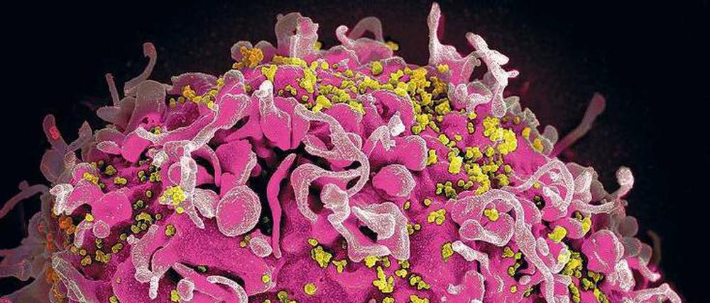 Infiziert. Elektronenmikroskopische Aufnahme von HIV-Viren, die eine menschliche Zelle kapern.