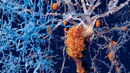 Alzheimer-Ablagerung im Gehirn