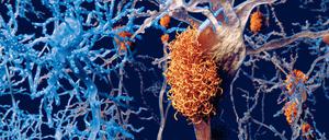 Alzheimer-Ablagerung im Gehirn