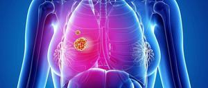 Gefahr in der Lunge. Die grafische Darstellung zeigt zwei Geschwülste in der rechten Lunge.