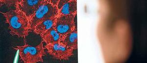 Schock. Das ist oft die erste Reaktion auf Krebs. Im Bild eine Melanom-Zelle.