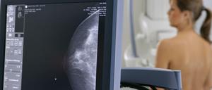 Wenn bei der Mammografie ein "duktales Karzinom" in der Brust entdeckt wird, verbessert eine radikale Amputation die Überlebenswahrscheinlichkeit nicht, so eine Studie an über 100.000 Frauen. 