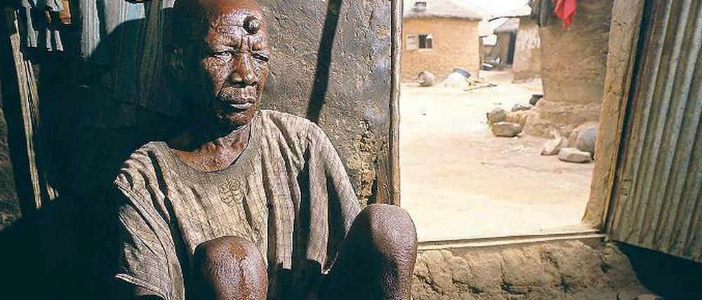 Zerstörerische Parasiten. Etwa 25 Millionen Menschen sind mit Fadenwürmern infiziert, die Flussblindheit auslösen. Durch Ivermectin, dessen Entwickler jetzt mit dem Nobelpreis belohnt wurden, ist die Krankheit in Mexiko, Ecuador und Kolumbien bereits verschwunden. 
