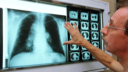 Entzündliche Verdichtungen des Gewebes sind gerade bei bakteriellen Pneumonien auf dem Röntgenbild oft gut sichtbar.
