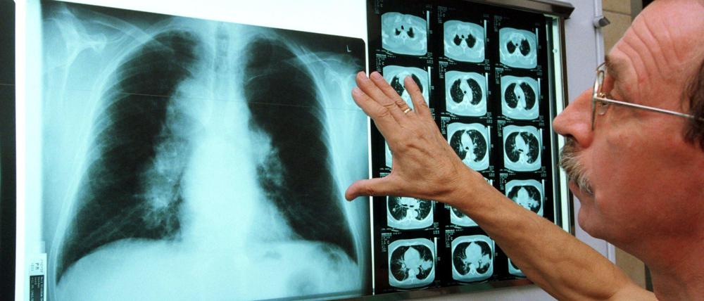 Entzündliche Verdichtungen des Gewebes sind gerade bei bakteriellen Pneumonien auf dem Röntgenbild oft gut sichtbar.