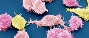 Rasterelektronenmikroskopische Aufnahme von Krebszellen. In ihnen hat die Erbgut-Korrektur versagt. 