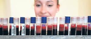 Die Gentherapie Glybera korrigiert einen Defekt, der das Blut verfettet.