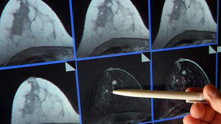 Auf der Bildschirmdarstellung einer Magnetresonanz-(MR)-Mammographie ist ein winziger Tumor in der Brust einer Patientin zu sehen. 