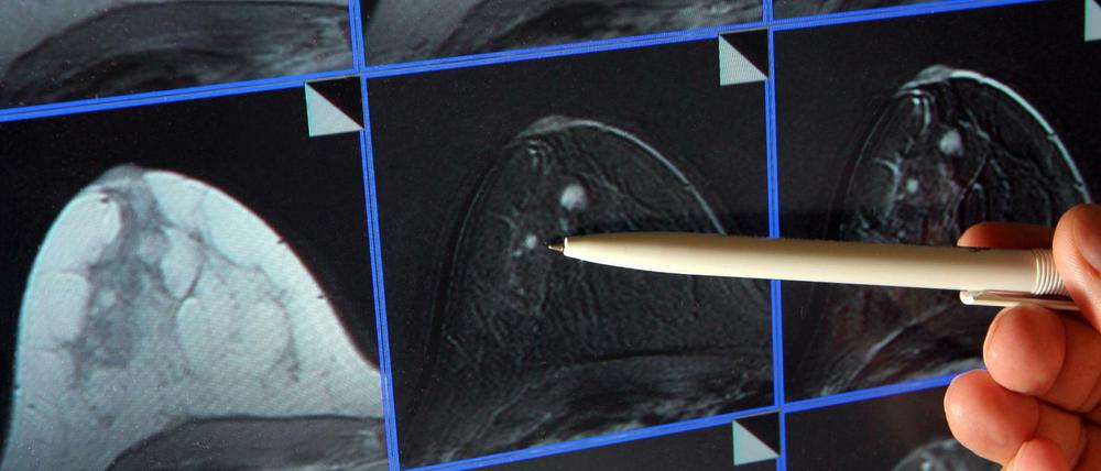 Auf der Bildschirmdarstellung einer Magnetresonanz-(MR)-Mammographie ist ein winziger Tumor in der Brust einer Patientin zu sehen.