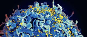 Gelbe Gefahr. Die rasterelektronenmikroskopische Aufnahme zeigt gelb eingefärbte Immunschwächeviren auf der Oberfläche einer blau eingefärbten T-Zelle. Diese Zellen gehören zum Immunsystem des Organismus und sind das Hauptziel des Aids-Erregers. 