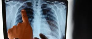 Diagnose mit Röntgen. Viele Flüchtlinge haben ein geschwächtes Immunsystem und sind deshalb anfällig.