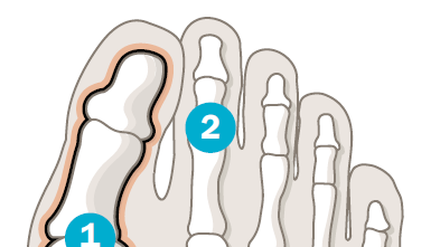 Der Hallux valgus ist eine Fehlstellung des großen Zehs, der nicht mehr parallel zu den übrigen Zehen steht. Das Großzehengrundgelenk (1) kippt dabei stark nach außen und verändert dadurch die Zugrichtung einiger Sehnen. Diese zerren am großen Zeh, ziehen ihn über oder unter den langen Zeh (2) und bringen ihn so immer stärker in die Fehlstellung.