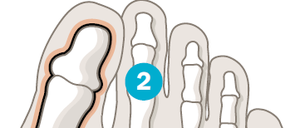 Der Hallux valgus ist eine Fehlstellung des großen Zehs, der nicht mehr parallel zu den übrigen Zehen steht. Das Großzehengrundgelenk (1) kippt dabei stark nach außen und verändert dadurch die Zugrichtung einiger Sehnen. Diese zerren am großen Zeh, ziehen ihn über oder unter den langen Zeh (2) und bringen ihn so immer stärker in die Fehlstellung.