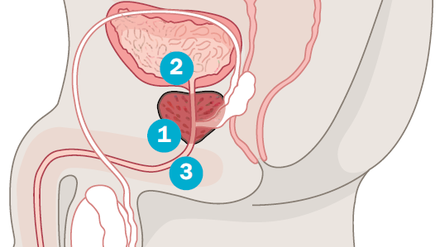 Die Prostata (1) ist eine etwa kastaniengroße Drüse, die unterhalb der Harnblase (2) sitzt und einen Teil der Harnröhre (3) umschließt. Bei vielen Männern beginnt das Organ allerdings im Alter aus unerfindlichen Gründen zu wachsen. Das wuchernde Drüsengewebe engt die Harnröhre ein und drückt auf den Blasenboden. Die Folgen: Schwierigkeiten beim Wasserlassen, schmerzhafter Harndrang, Blasenkrämpfe.