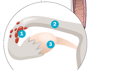 Endometrioseherde (1), also chronische, gutartige Wucherungen von Gebärmutterschleimhaut, finden sich meist im Bereich des Beckens, sehr häufig in den Eileitern (2) oder Eierstöcken (3).