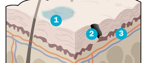 Ein Druckgeschwür (Dekubitus) wird in vier Schweregrade eingeteilt. Zuerst verfärbt sich die Haut bläulich (1). Beim zweiten Grad sind offene Stellen mit Abschürfungen erkennbar (2). Bei Grad drei ist auch das unter der Haut liegende Gewebe zerstört (3). Im vierten Grad sind Muskeln und Knochen betroffen (4).
