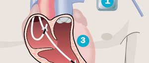 Der Herzschrittmacher (1) wird meist knapp unter dem Schlüsselbein unter die Haut gesetzt. Über eine Vene (2) gelangen die Elektrodenkabel zum Herzen (3), werden dort im Muskel verankert.