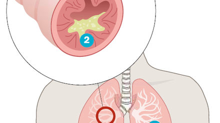 Die COPD ist eine chronische Entzündung der unteren Atemwege (1). In den entzündeten und verengten Bronchien (2) setzt sich zäher Schleim ab - Hustenattacken und schwere Luftnot sind die Folge.