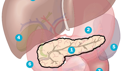 Bei einem Diabetes mellitus Typ 1 kann die Bauchspeicheldrüse (1) kein eigenes Insulin mehr produzieren. Ohne dieses Hormon können die Zellen keinen Zucker aufnehmen und somit keine Energie. Darauf sind jedoch alle Zellen im Körper angewiesen, auch die von wichtigen Organen wie Magen (2), Leber (3), Gallenblase (4), Milz (5), Zwölffingerdarm (6) oder Niere (7).