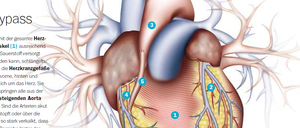 Als Bypass soll bevorzugt eine bestimmte Ader verwendet werden, die so genannte Brustwandarterie. Diese verspricht eine lange Funktion, ohne schnell wieder zuzuwuchern. Das ist eine der Vorgaben, mit der zentral die Qualität von Herzoperationen in deutschen Kliniken überwacht wird. 45.000 Operationen werden jährlich in Deutschland durchgeführt, um einen Bypass zu legen.