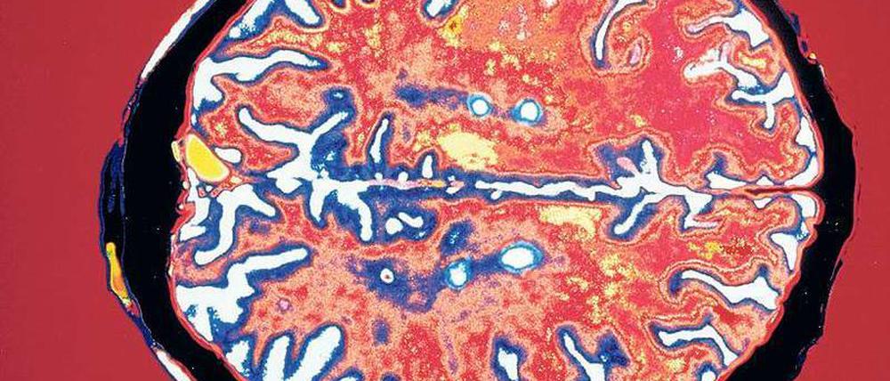 Kabelbrand. Blick in das Gehirn eines MS-Patienten. Gelb markiert sind Krankheitsherde. 