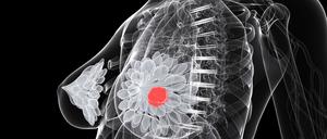 Frauen sollten sich regelmäßig selbst abtasten und bei Auffälligkeiten sofort zum Arzt gehen, raten Experten.