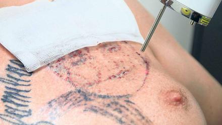 Jeder zehnte Deutsche ist tätowiert, schätzen Experten. Elf Prozent von ihnen wollen aber die Tattoos wieder loswerden. 