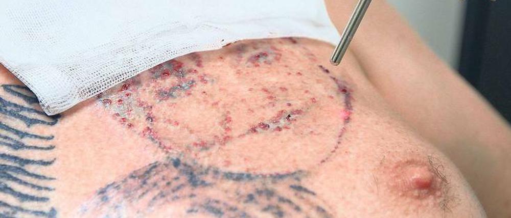 Jeder zehnte Deutsche ist tätowiert, schätzen Experten. Elf Prozent von ihnen wollen aber die Tattoos wieder loswerden. 