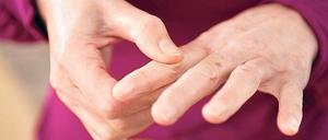Das schmerzt. Arthrose in den Fingern macht vielen zu schaffen. 